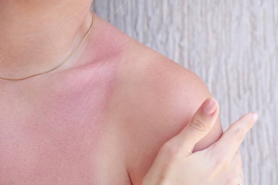 A person's shoulders with sunburn after exposure.